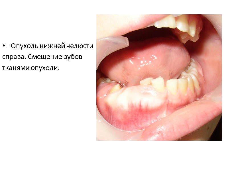 Опухоль нижней челюсти  справа. Смещение зубов  тканями опухоли.
